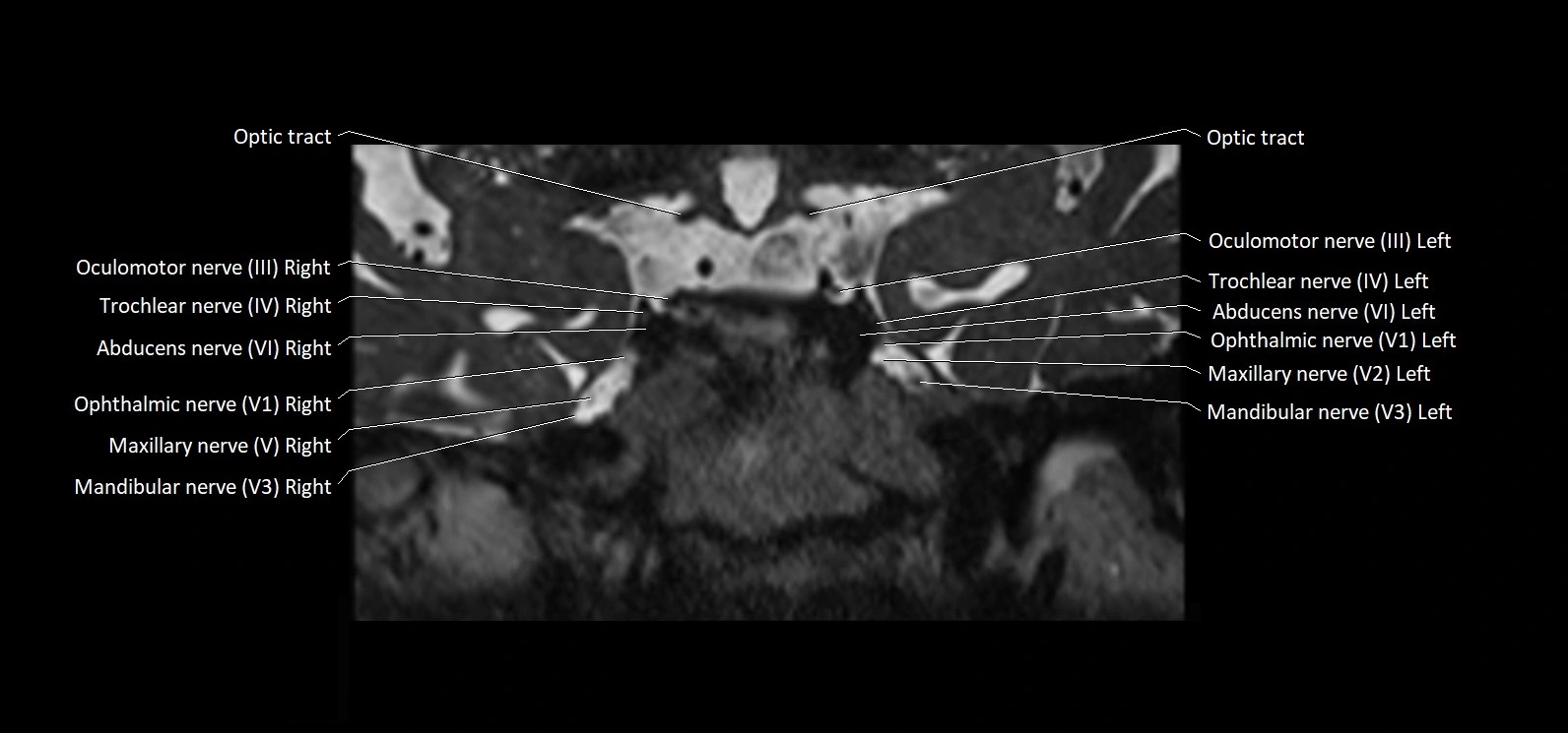 Cranial nerve cross sectional anatomy coronal 3T MRI image 32.webp